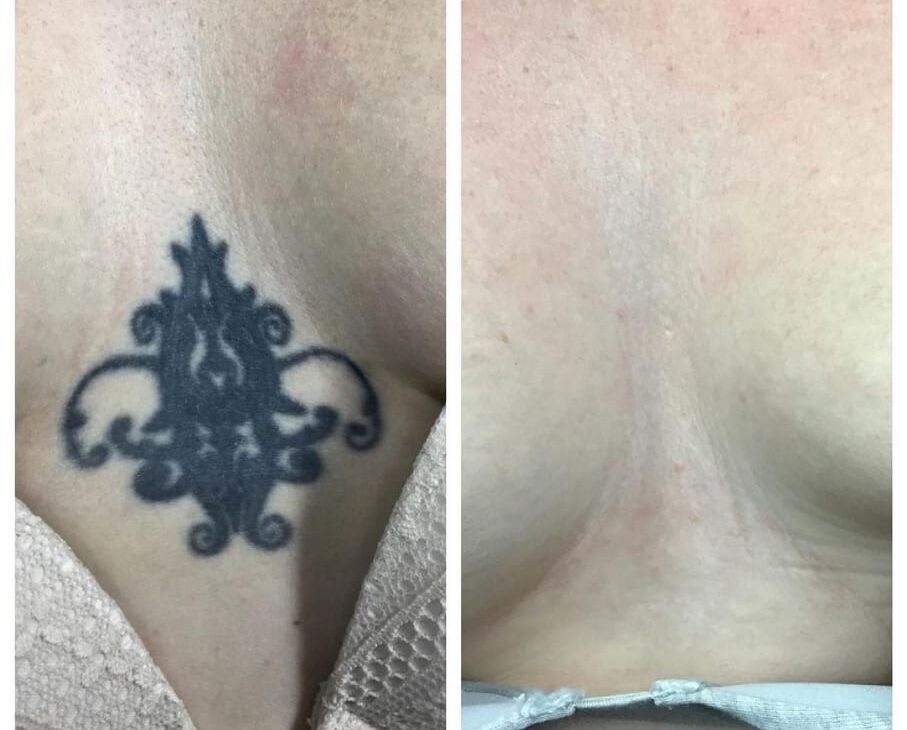 disappearinginc Tattoo removal