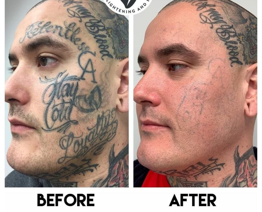 sacredlaser shop Tattoo removal before and after on face